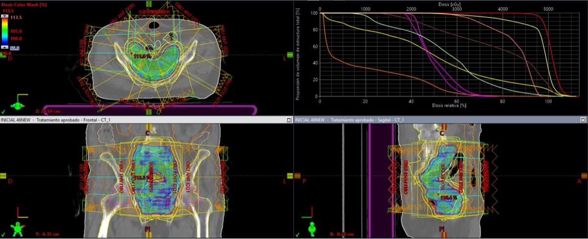 Radioterapia Conformada Tridimensional (3D-CRT)