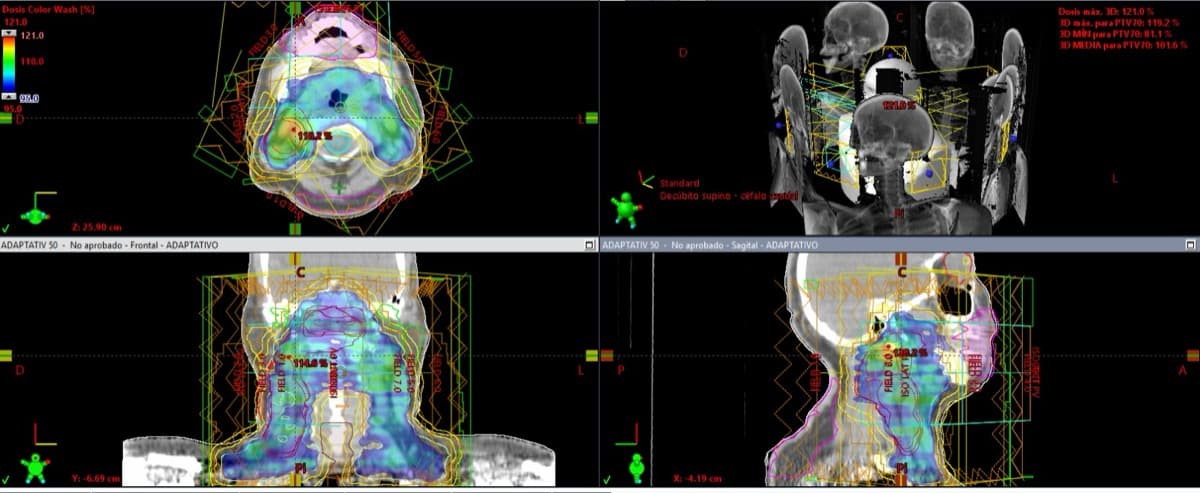 Radioterapia de Intensidad Modulada (IMRT)
